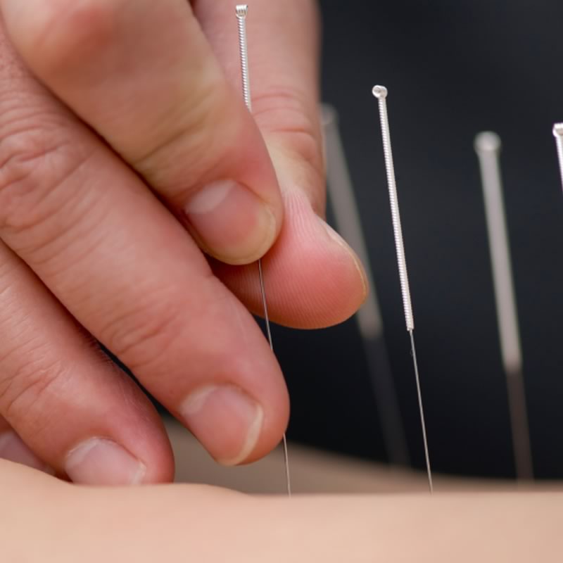 Is Acupuncture Halal?