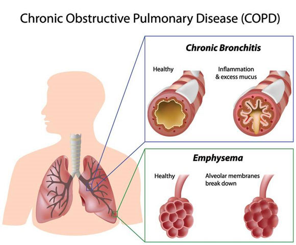 Global Alliance Against Chronic Respiratory Disease