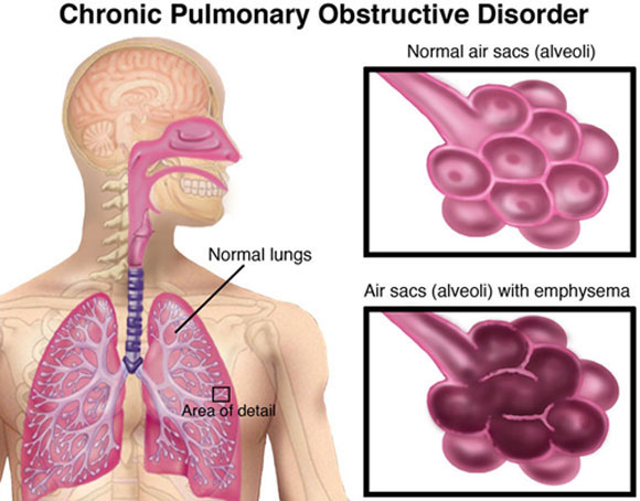 Chronic Obstructive Pulmonary Disease Will Be 3rd Killer by 2030; Here is Why - About Islam