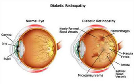 Fighting Diabetes by Studying Fruit Fly - About Islam