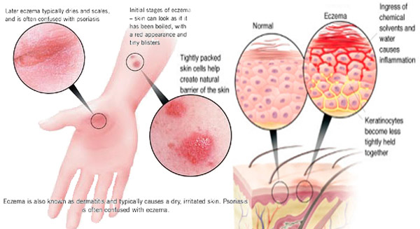 How to Deal with Winter Eczema - About Islam