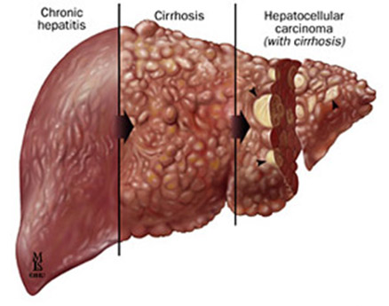 Hepatitis: Understanding the Enemy - About Islam