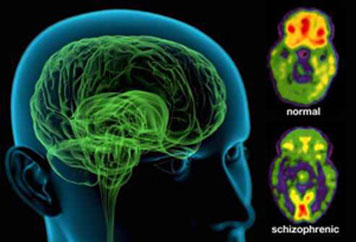 A person diagnosed with schizophrenia may experience hallucinations (most reported are hearing voices), delusions (often bizarre or persecutory in nature), and disorganized thinking and speech.