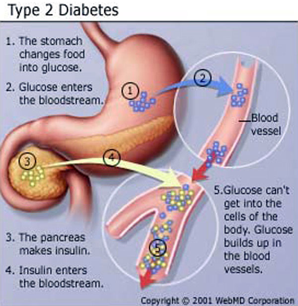 Adult Diabetes in Children