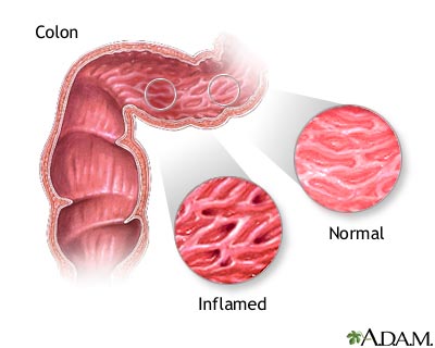 Inflammation: Savior or Silent Killer?