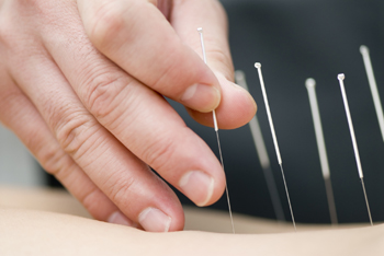 Acupuncture healing
