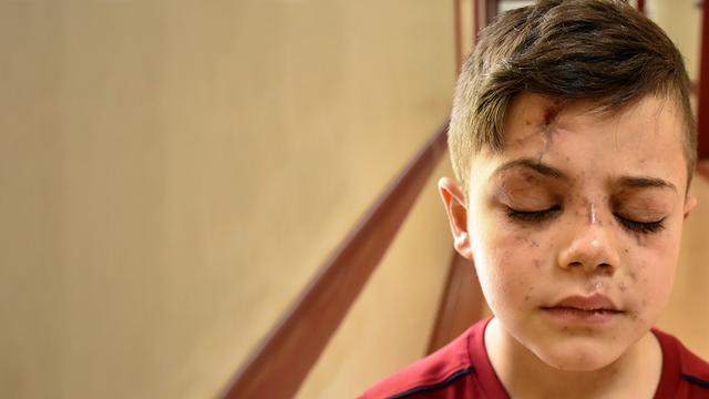 Syrian Boy Traumatized at losing His Sight Due to War