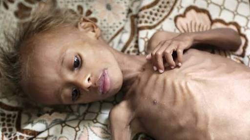 Yemen on Verge of World's Worst Famine in 100 Years