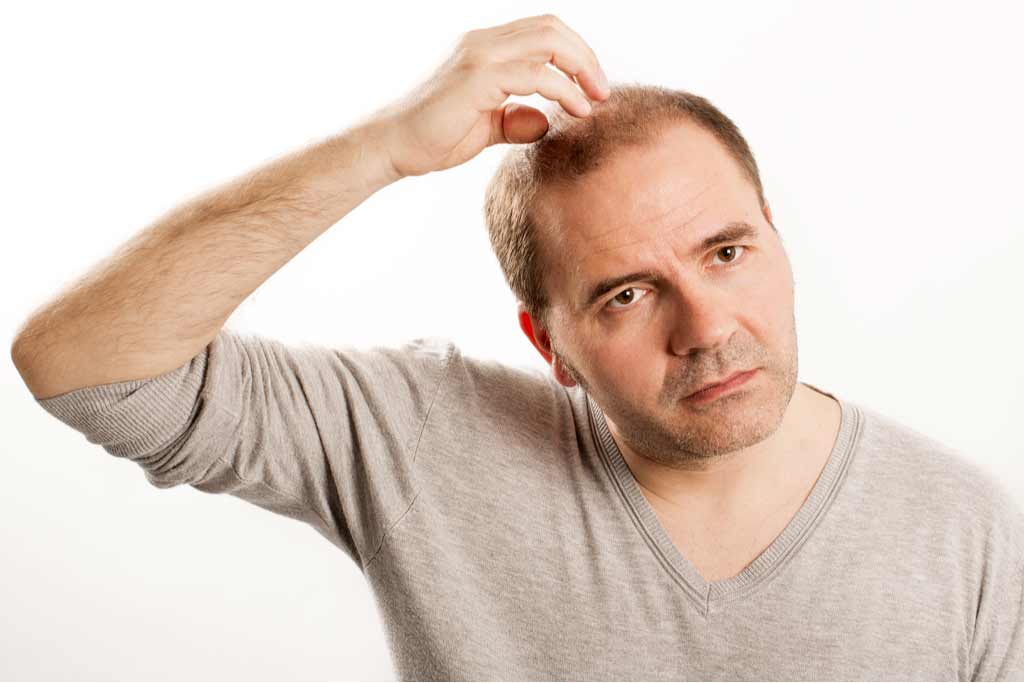 Is Hair Transplantation Permitted for Muslims?