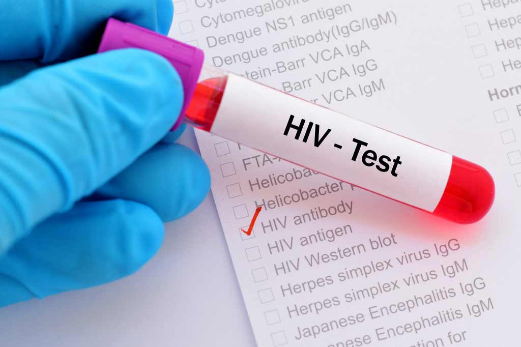 Is It Necessary to Undergo HIV Test Before Marriage?