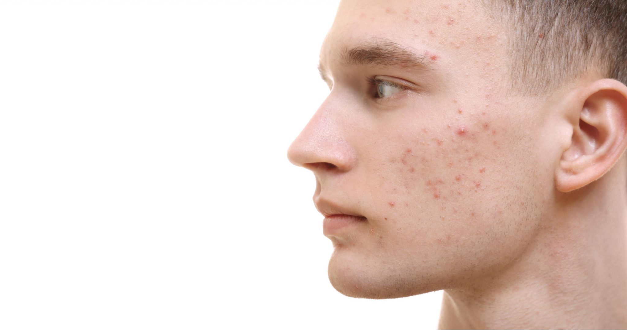 Will Parents Pass Acne Skin to Their Kids?