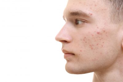 Will Parents Pass Acne Skin to Their Kids?